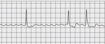<p>Lots of P waves are present (continuous stimulation)</p><ul><li><p>QRS firing prematurely or long period of nonfiring</p></li></ul><p></p>
