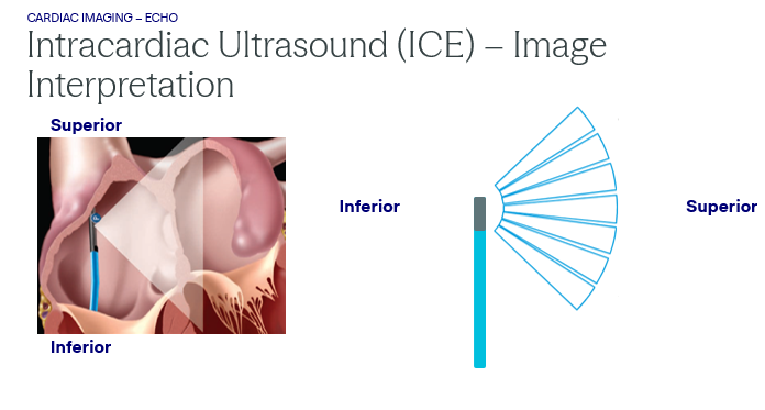 <p>Intracardiac Ultrasound (ICE)</p>