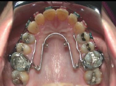 <p>Maxillary expansion</p>