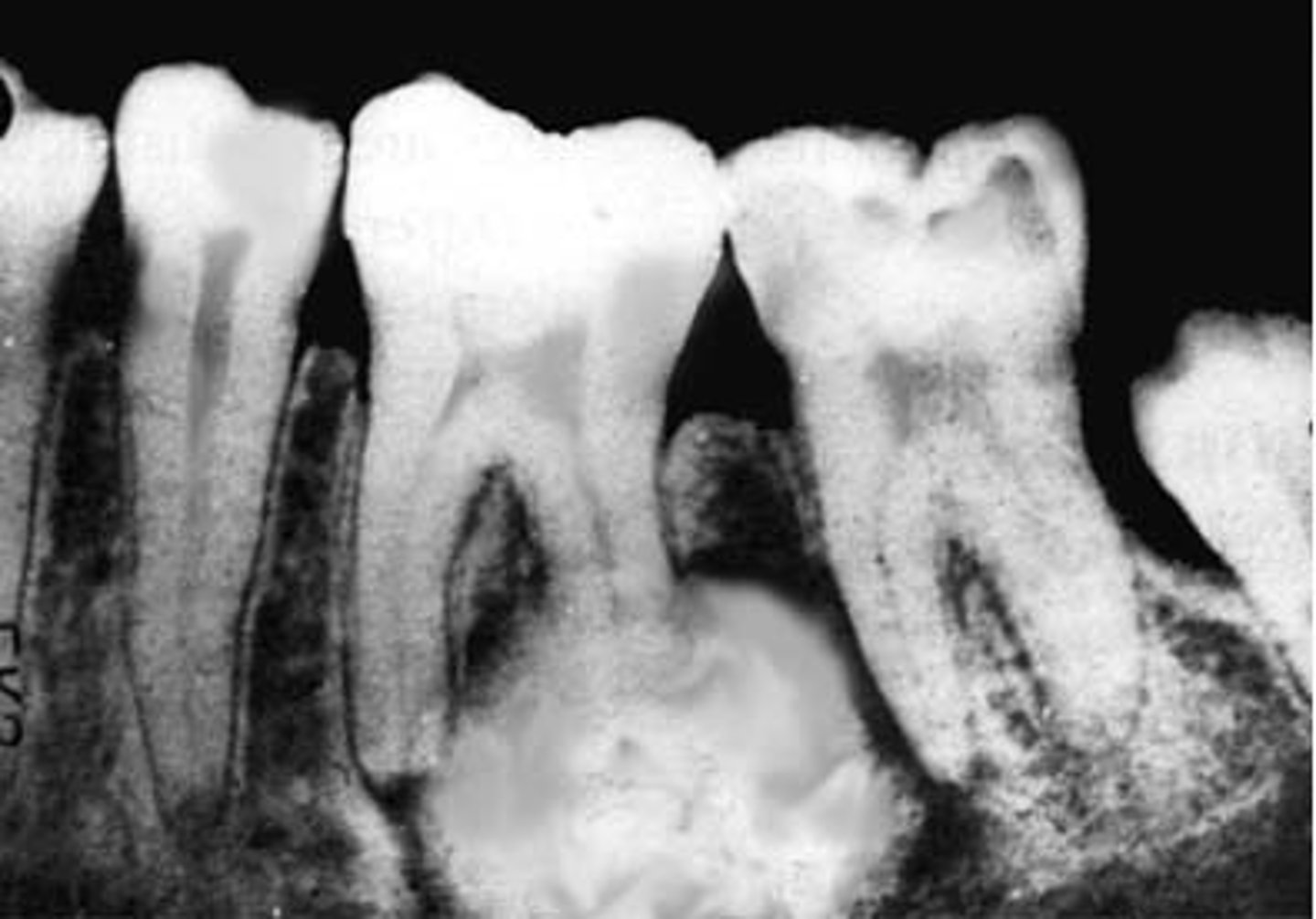 <p>Inflammation of the bone and the bone marrow secondary to infection</p>