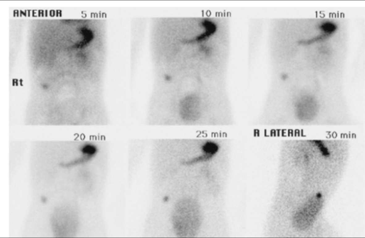 <p>After acquiring the images below on a patient suspected of having a Meckel's diverticulum, the technologist should ___________.</p><p>image again in 1 - 2 hours</p><p>administer a different radiopharmaceutical and reimage</p><p>submit the images for reporting, the exam is complete</p><p>check the radiochemical purity</p>