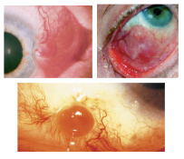 <p>What is the most likely diagnosis ?</p>