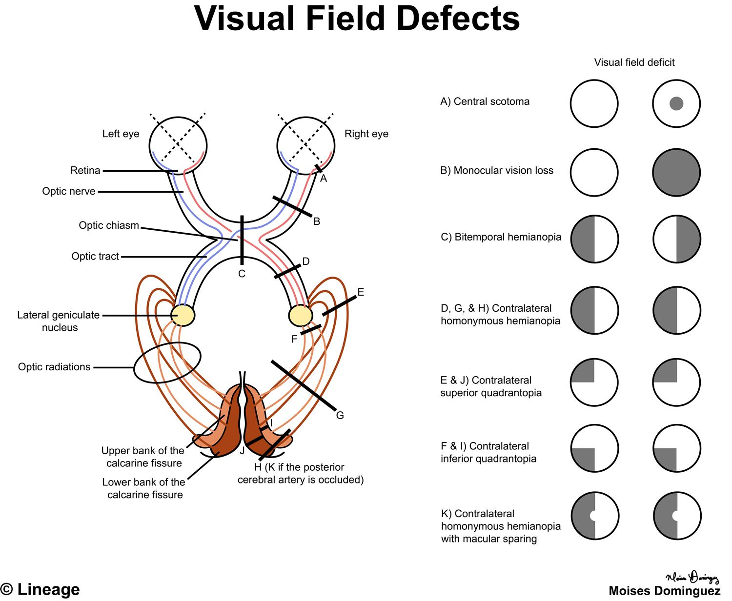 <p>optic nerve→optic chiasm (crosses over to other lobe)→optic tract→occipital lobe</p>
