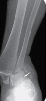 <p>Ankle fracture affecting both the distal tibia (medial malleolus) and distal fibula (lateral malleolus)</p>