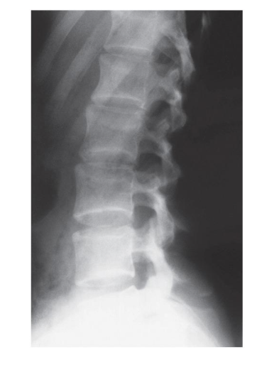 <p>What view of the lumbar spine is this?</p>