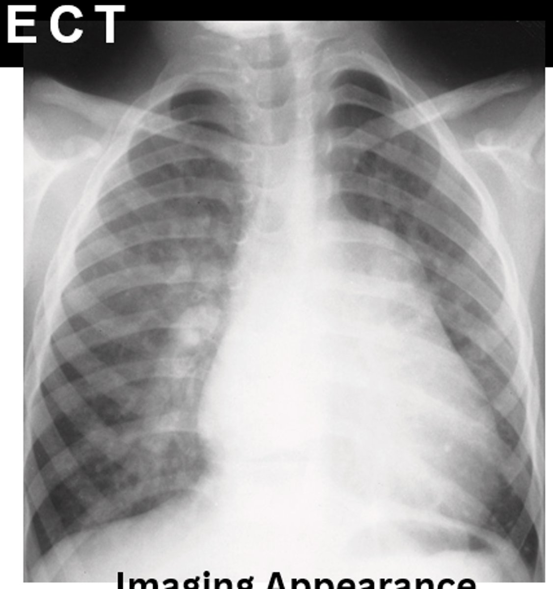 <p>B. CHD ventricular septal defect</p>