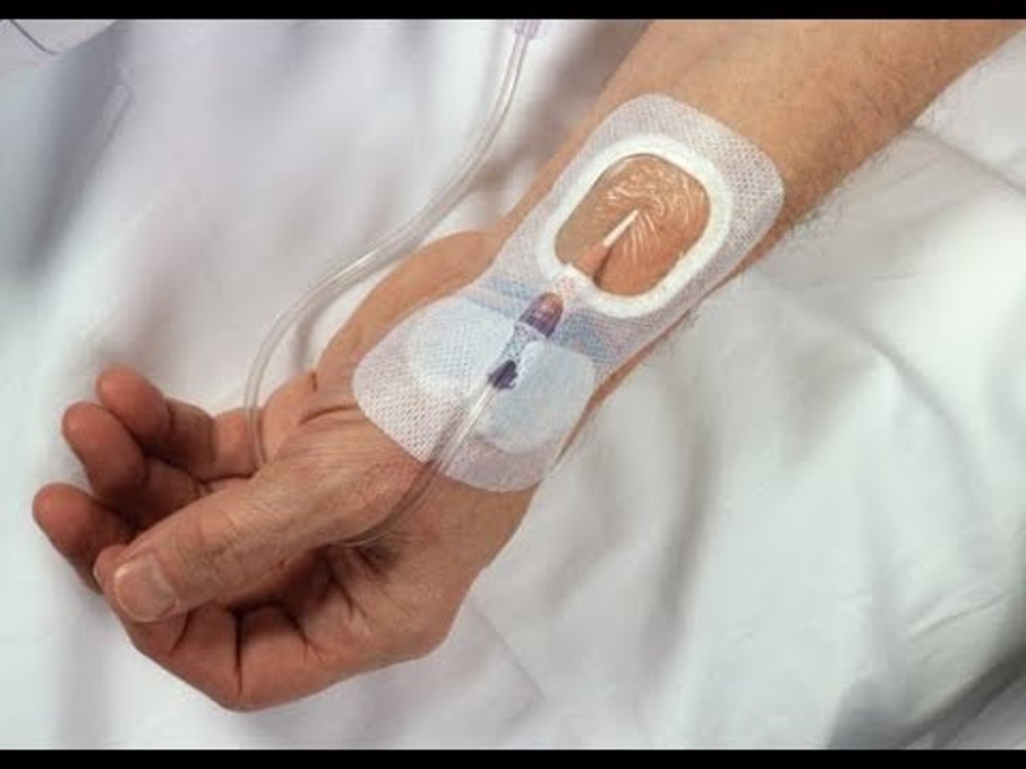 <p>monitor arterial blood gases</p><p>-if dislodged, apply firm pressure and alert nursing immediately </p>