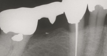 <p>30% show amalgam particles on xray </p>