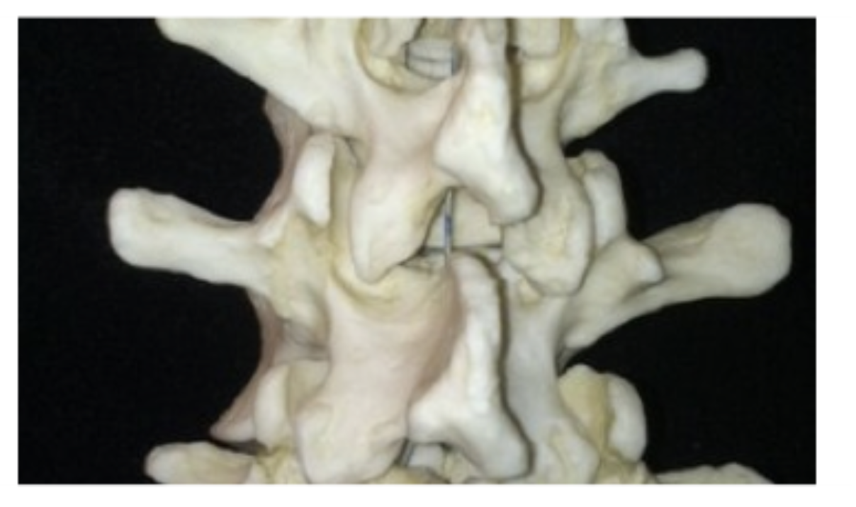 <p>Where should needle be insterted when perfroming left inferior facet injection</p>