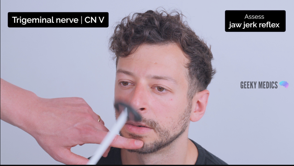 <ul><li><p>Normal jaw jerk reflex - slight closure of the mouth in response to tapping the chin with the tendon hammer.</p></li><li><p>Absent / reduced jaw jerk reflex if there is damage to the nerve itself.</p></li><li><p>Exaggerated / hyperactive jaw jerk reflex if there is UMN pathology.</p></li></ul><p></p>