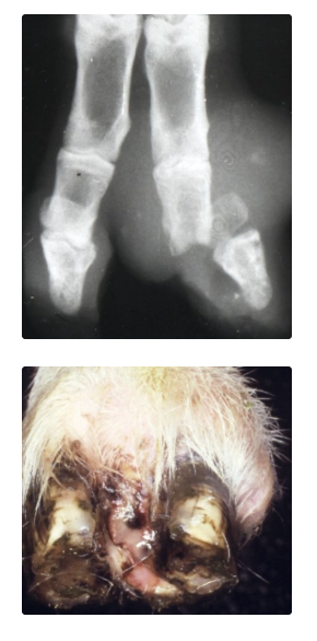<p><u>Agent:</u> <em>Trueperella pyogenes</em> infection 2˚ to OID which allows breach of skin integrity of the interdigital space</p><p><u>Signalment:</u> Heavy ewes and rams</p><ul><li><p>Small number of severely lame animals (non-weight bearing)</p></li></ul><p><u>Treatment:</u> Difficult as most cases are advanced</p><ul><li><p>Cannot insert scalpel to drain as vital structures around foot</p></li></ul><ol><li><p>Do nothing → recovery in 1 - 2m (ankylosis and bone fusing BUT very painful and welfare concern)</p></li><li><p>Consider culling as single dose of antibiotics not effective</p></li><li><p>Amputation of affected digit if appropriate</p></li></ol><p></p>