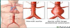 <p>risk factors of Abdominal Aortic Aneurysm/ AAA</p>