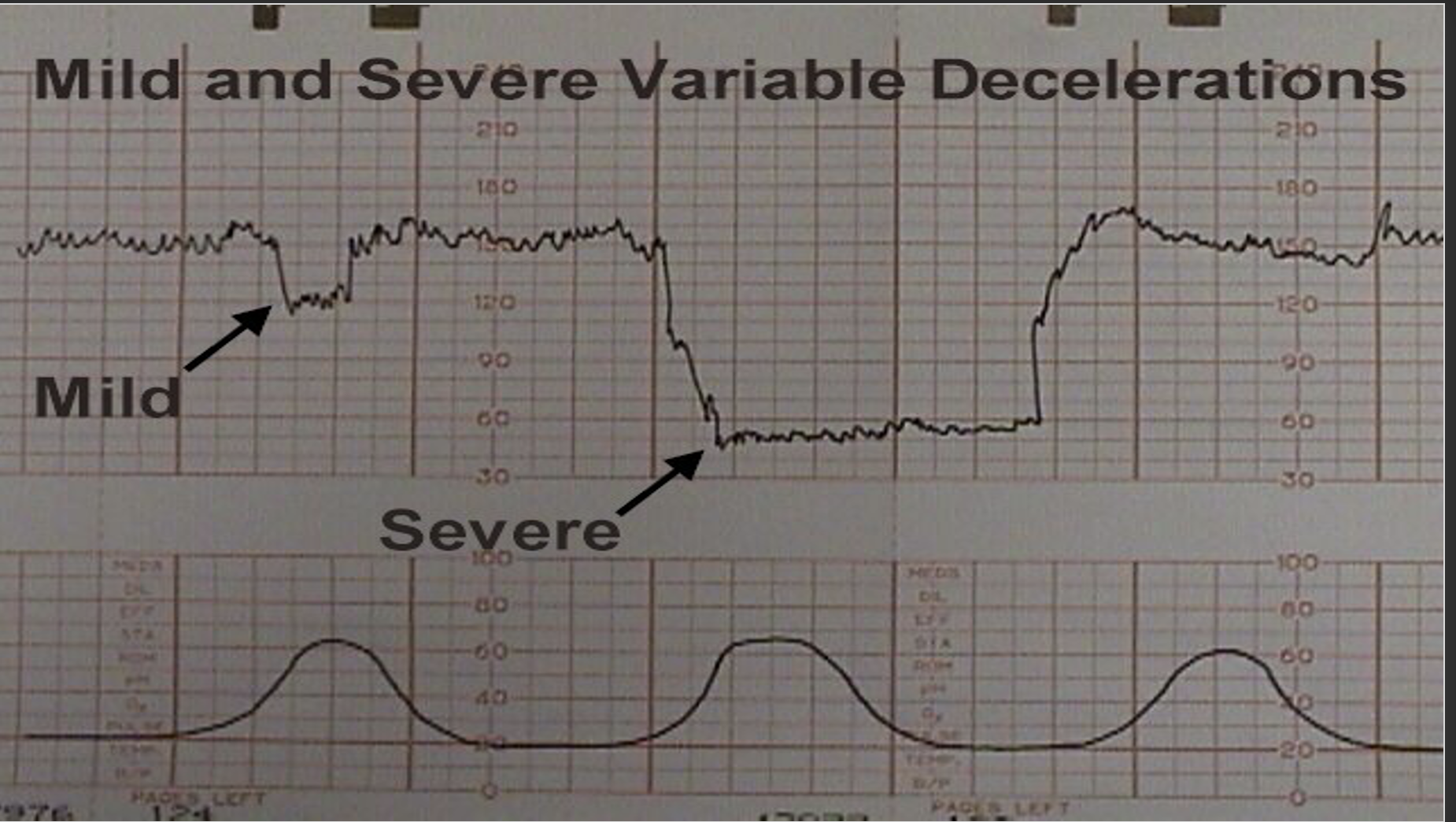 <p><strong>Management of Variables </strong></p><ul><li><p>Change position to where FHR pattern is most improved. </p></li><li><p>Trendelenburg may be helpful.</p></li><li><p>Discontinue oxytocin if infusing.</p></li><li><p>Check for cord prolapse or imminent delivery by vaginal exam.</p></li><li><p>Consider amnioinfusion if r/t ROM.</p></li><li><p>Administer 100% O2 by non-rebreather face mask.</p></li></ul><p></p>