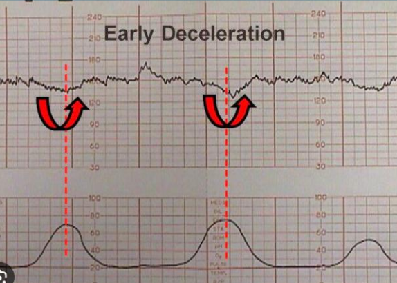 <p>Normally occur late in labor when fetal head is <u>descended</u>; innocent</p>