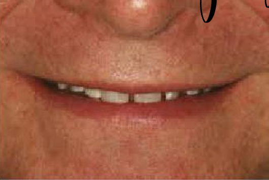 <p>decreased incisor display</p><p>gets lower with age</p>