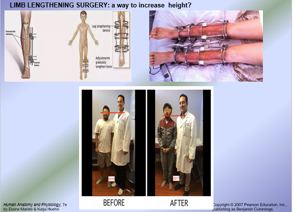 <ul><li><p>Hypersecretion of growth hormone = excess growth hormone release in children = gigantism = excessive height increae</p></li><li><p>Excess growth hormone release in adults after epiphyseal plate closure leads to acromegaly = excessive increase in appositional bone growth</p></li><li><p>Dwarfism = very short stature may be caused by:</p><ul><li><p>Hyposecretion of growth hormone = growth hormone deficiency </p></li><li><p>Absence of growth hormone receptors on hepatocytes thus IGFs are not produced</p></li><li><p>Enzymatic defects in the biosynthesis of IGFs by the hepatocytes = IGF deficiency </p></li><li><p>Absence of IGF receptors on chondroblasts in the epiphyseal plates = decrease in chondroblast proliferation </p></li></ul></li></ul><p></p>