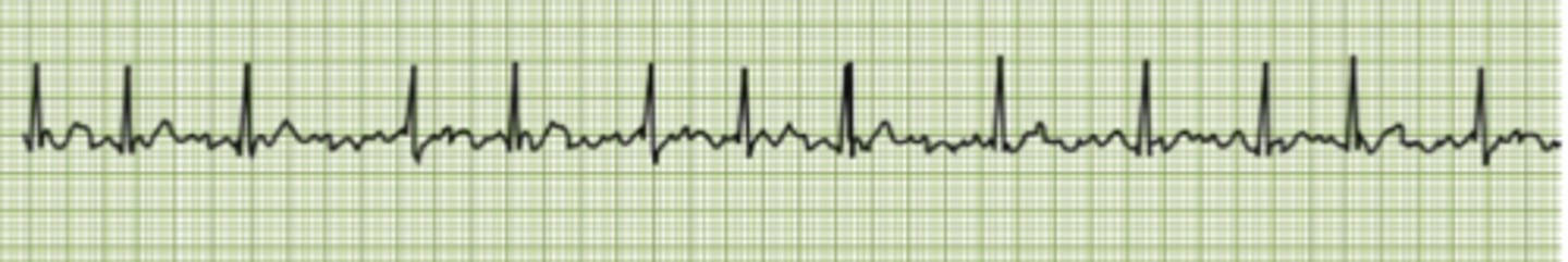 <p>can cause blood clots but not immediately life threatening. Looks like a squiggle before each QRS complex</p>