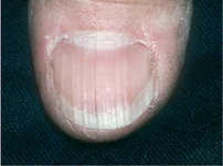 <p>Name this + its etiology</p>