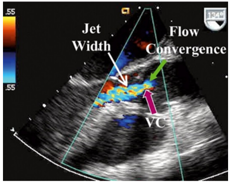 <ul><li><p><strong>Vena contracta</strong>: narrowest part of the jet in the area between the proximal flow convergence zone and the regurgitant jet</p></li></ul><p><u>Steps: </u></p><ol><li><p>measure in PLAX</p></li><li><p>Zoom in on the aortic valve and LVOT</p></li><li><p>store cine that shows flow convergence dome, VC, and regurgitant jet</p></li><li><p>freeze and measure the narrowest portion of the AI jet</p></li></ol><p></p>