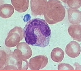 <p><span style="font-family: Arial, sans-serif;">agranular (lack visible cytoplasmic granules)</span></p><p class="MsoNormal"><strong>3-8%</strong> of the WBCs</p><p class="MsoNormal">Nucleus kidney or horse-shoe shaped</p><p class="MsoNormal"> • Largest WBC</p><p class="MsoNormal">Migrate to infected tissues– Differentiate into macrophage</p><ul><li><p class="MsoNormal">differentiate into phagocytes</p></li></ul><p class="MsoNormal">o<span style="font-family: "Times New Roman"; line-height: normal; font-size: 7pt;"> </span>V<strong><u>iruses/fungal</u></strong></p><p class="MsoNormal">o<span style="font-family: "Times New Roman"; line-height: normal; font-size: 7pt;"> </span>I<strong><u>ntracellular bacterial parasites</u></strong></p><p><span style="font-family: Arial, sans-serif;"><strong><u>Chronic infections (tuberculosis)</u></strong></span></p><p>Fixed in some tissues</p><p>– Lungs, lymph nodes</p><p> • Destroy microbes and clean up dead tissue</p><p>Low count indicates Bone Marrow Suppression, Treatment with Cortisol</p>