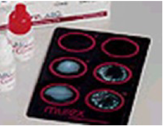 <p>• Arthritis: - caused by autoimmune antibodies</p><p>• Rheumatoid factor is an antibody to human IgG</p><p>• Serum containing RF (auto antibodies) is mixed with IgG coated particles</p><p>• RF’s bind to IgG causing agglutination</p><p></p><p>• Tests: - RF Latex, RF Slide</p><p>• Sample: - Serum</p><p>• Controls - Positive and Negative</p><p>• QC: - Store reagents at 2-6ºC; warm up to RT before using</p><p>• Other tests: - CRP (C-reactive protein), ESR</p>