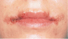 <p>herpes simplex virus</p>