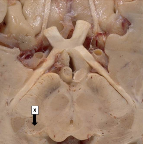 <p>Which one statement best describes structure X?</p><p>This is the lateral geniculate nucleus and is a thalamic relay between the inferior colliculus and the auditory cortex</p><p>This is the lateral geniculate nucleus and is a thalamic relay between the optic tracts and the visual cortex</p><p>This is the medial geniculate nucleus and is a thalamic relay between the inferior colliculus and the auditory cortex</p><p>This is the medial geniculate nucleus and is a thalamic relay between the optic tracts and the visual cortex</p><p>This is the medial geniculate nucleus and is a thalamic relay between the superior colliculus and the auditory cortex</p>