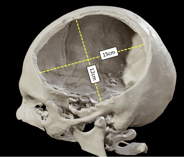 <ul><li><p>Reduce intracranial pressure after malignant MCA stroke</p></li><li><p>Bone flap is removed until swelling is reduced</p></li></ul><p></p>
