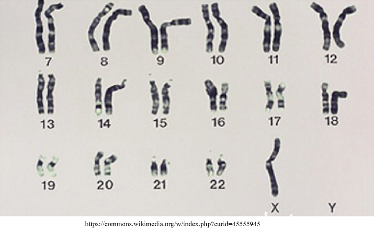 <p>monosomy</p><p>(ex: monosomy X = Turner syndrome)</p>