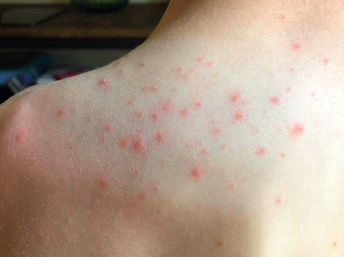 <p><span style="color: blue;">Schistosomiasis can cause what in humans in the US?</span><span> Patent or nonpatent infection?</span></p>