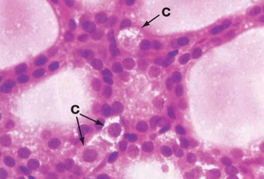 <p>Microscopically, the thyroid is composed of spherical follicles, each composed of a single layer of follicular cells surrounding a lumen filled with colloid</p>