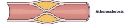 <p>Chronic form of ischemic heart disease IHD</p><p>Occurs with increased myocardial oxygen demand and reduced blood flow during exertion or emotional stress</p><p>Clinical Manifestations</p><ul><li><p>related to exertion</p></li><li><p>resolve with rest or short acting nitroglycerin (vasodilator medication used primarily to treat and prevent acute chest pain (angina) caused by coronary artery disease)</p></li></ul><p>a predictable type of chest discomfort that occurs when your heart muscle does not get enough oxygen-rich blood during physical exertion or emotional stress</p>