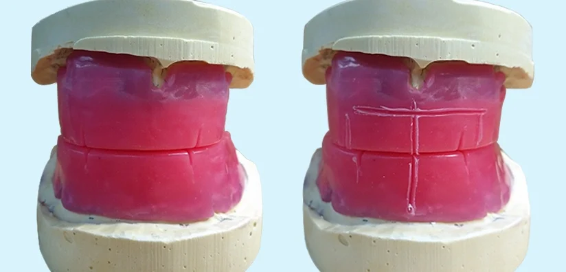 <p>Bite Rim</p>
