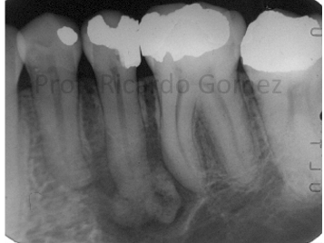 <p>focal cemento-osseous dysplasia </p>