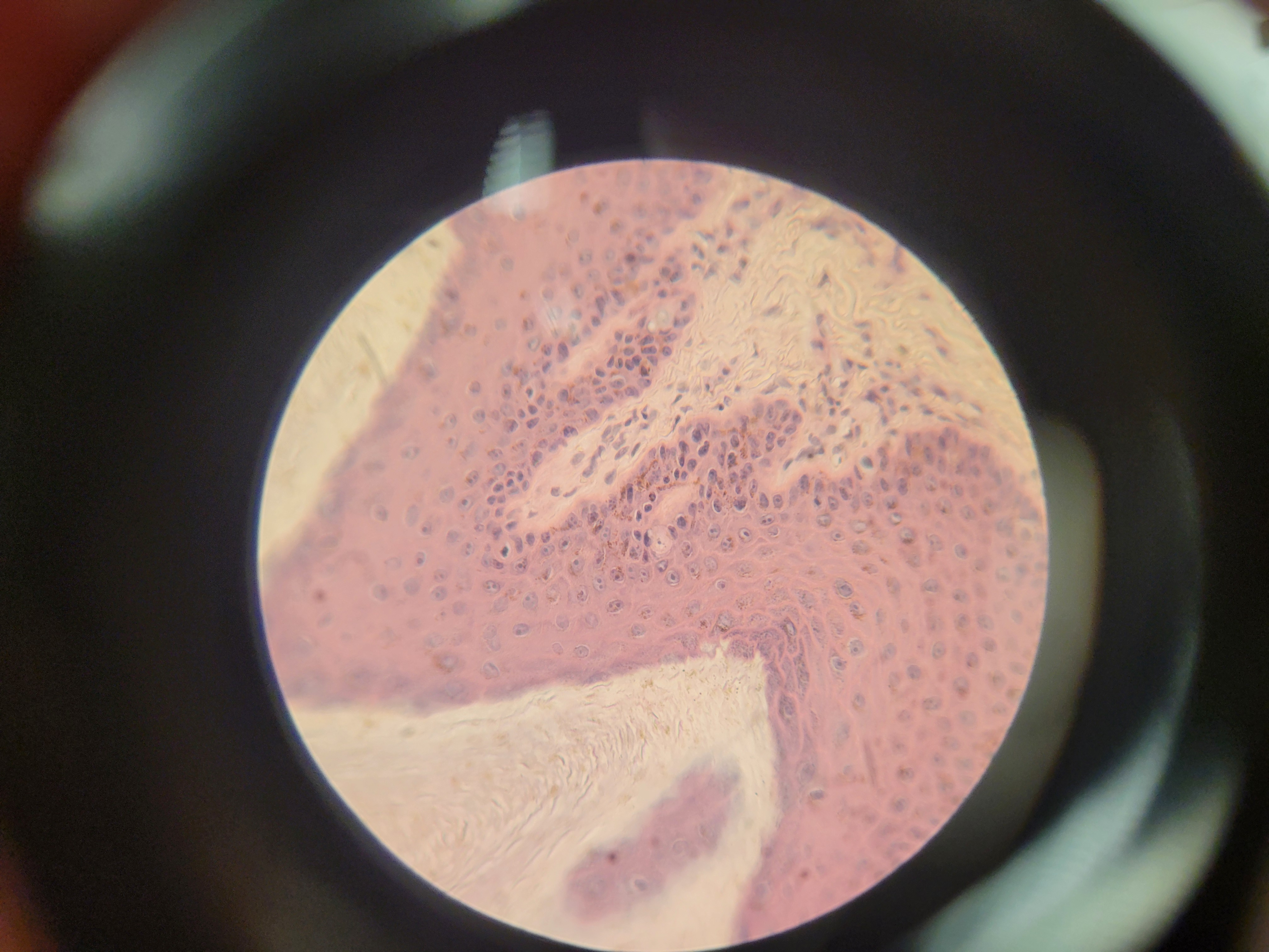 <p>-Skin cornified </p>