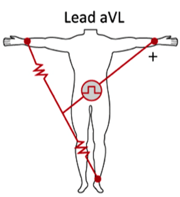 <p>aVL</p>
