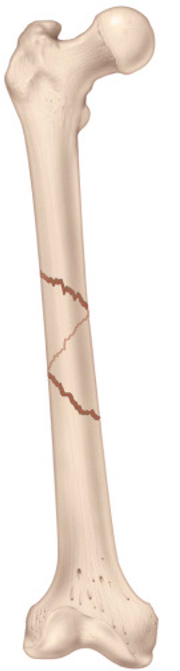 <p>TWISTS around the bone fracture</p>