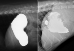 <p>What type of luminal defect is pictured on the right? (Left is normal)</p>