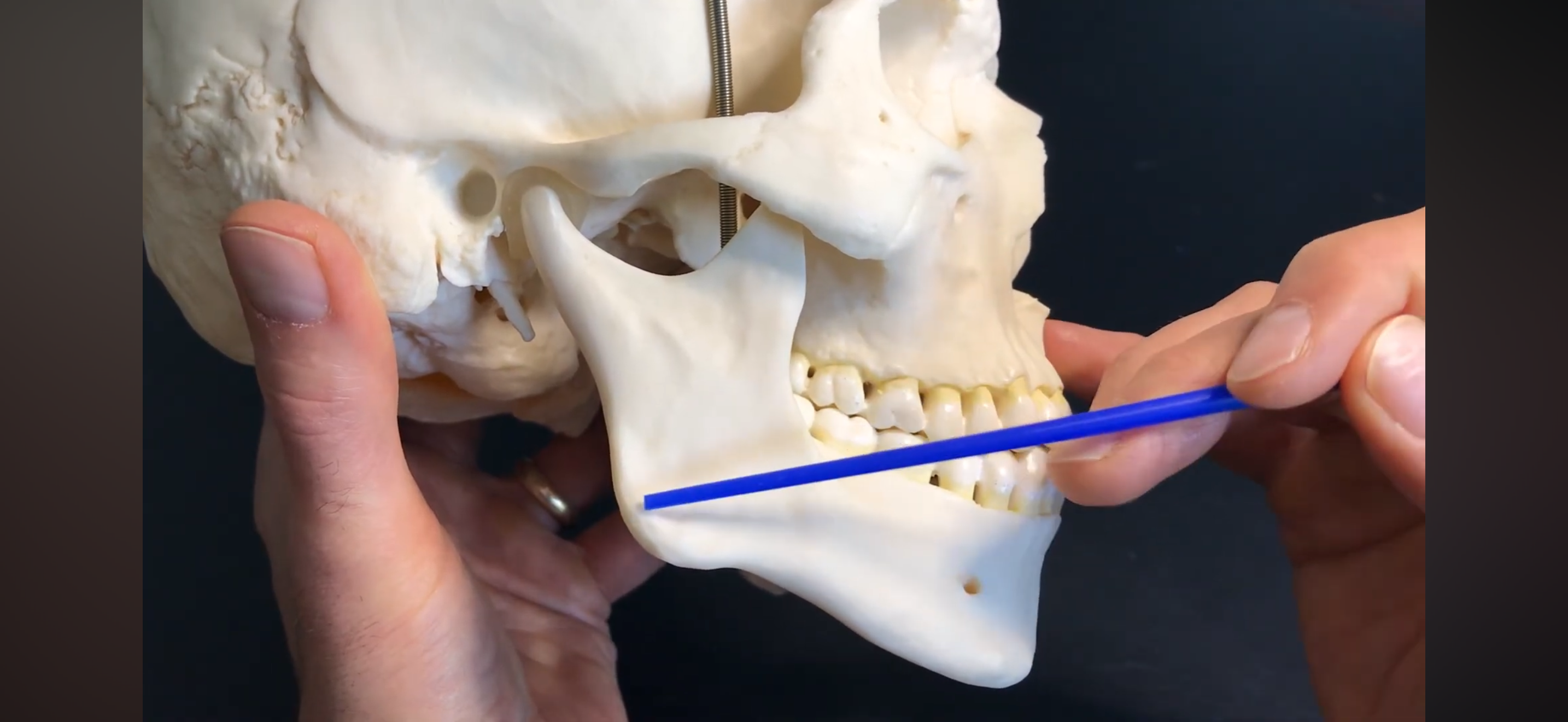<p>What PART of the mandible is this?</p>