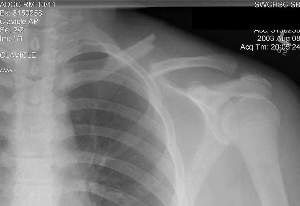 <p>Transverse mid-clavicle fx can get an</p>