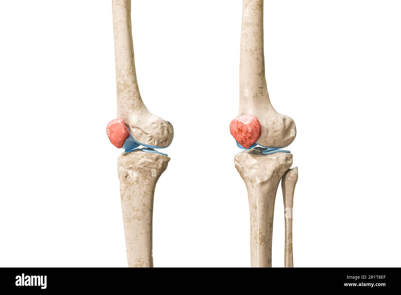 <p>The small bone covering the front of the knee (patella).</p>