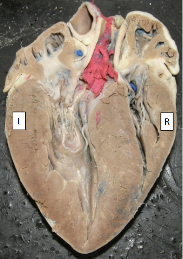 <p>Which side is the Left ventricle on?</p>