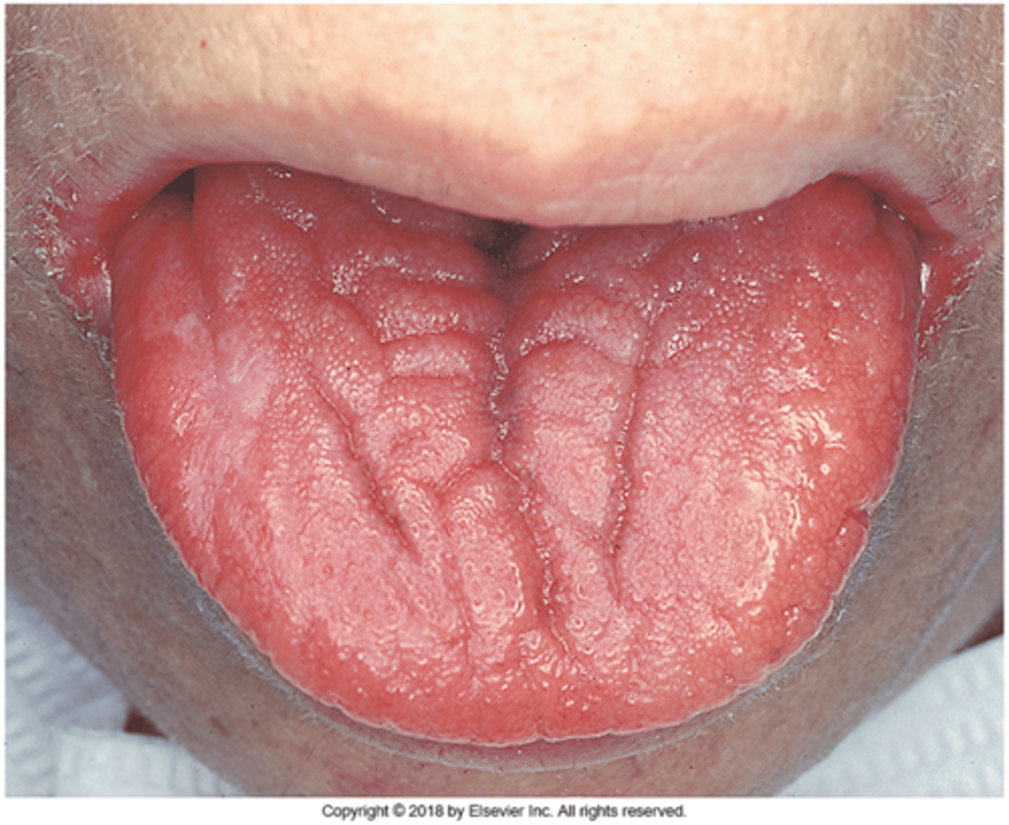 <p><span>-tongue is devoid of filiform papillae</span></p>