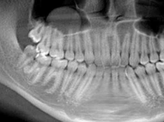 <p>dome shaped, faintly radiopaque lesions; arising from maxillary sinus; accumulation of inflammatory exudate; TX depends if lesion is symptomatic </p>
