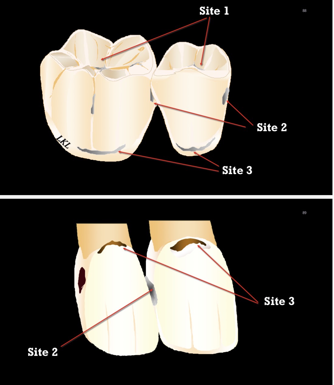<p>Les puits et fissures de toutes les dents ainsi que les zones lisses, sauf la zone cervicale.</p>