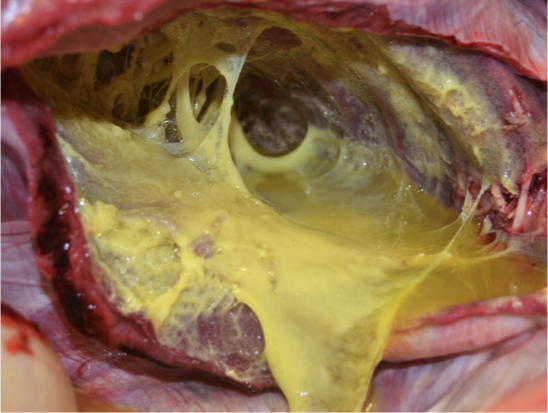 <p>What type of exudate is shown?</p>