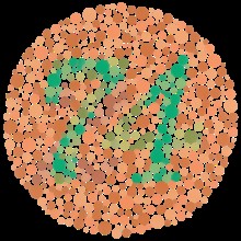 <p>X linked </p>