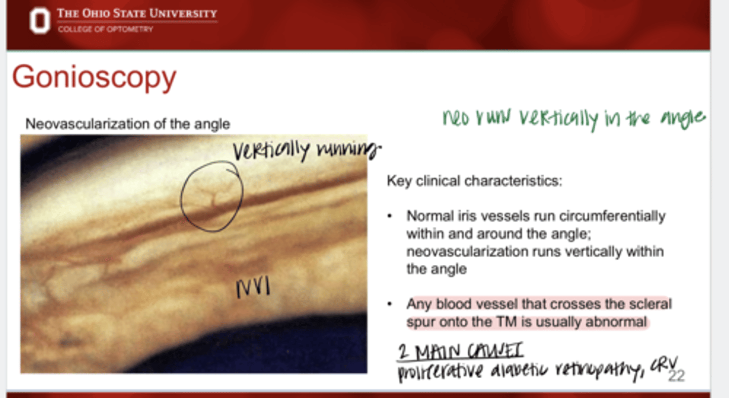 <p>True or False: </p><p>Any blood vessel that crosses the scleral spur onto the TM is usually abnormal</p>