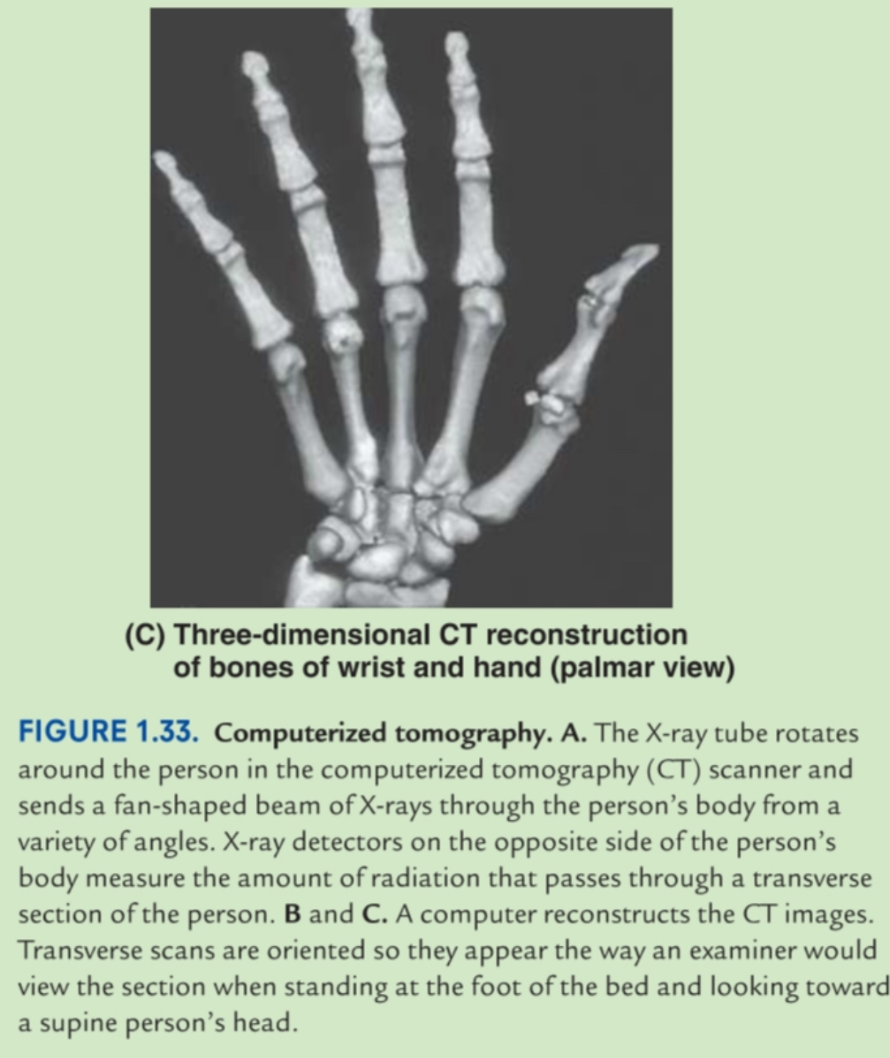 <p>CT reconstructed into 3D model</p>