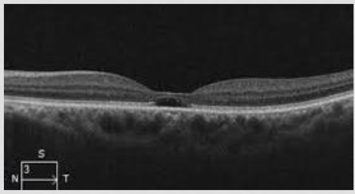 <p>outer retinal cystic formation → <strong>Macular cavitation</strong>; empty space/cavity with NO fluid</p><p>IZ gone; lost RPE and outer photor</p><p>EZ gone; loss of outer and inner photo r</p><p>damaged photor/RPE → decrease liposuscin</p>